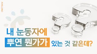 시력저하와 실명을 유발하는 아벨리노 증후군?