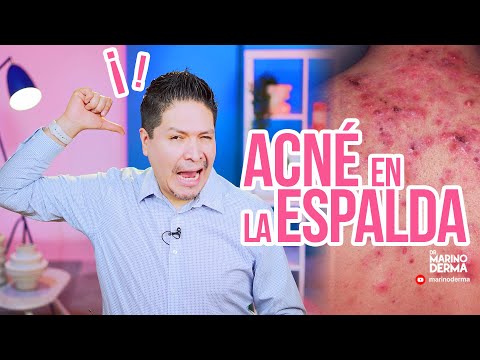 ACNE EN LA ESPALDA