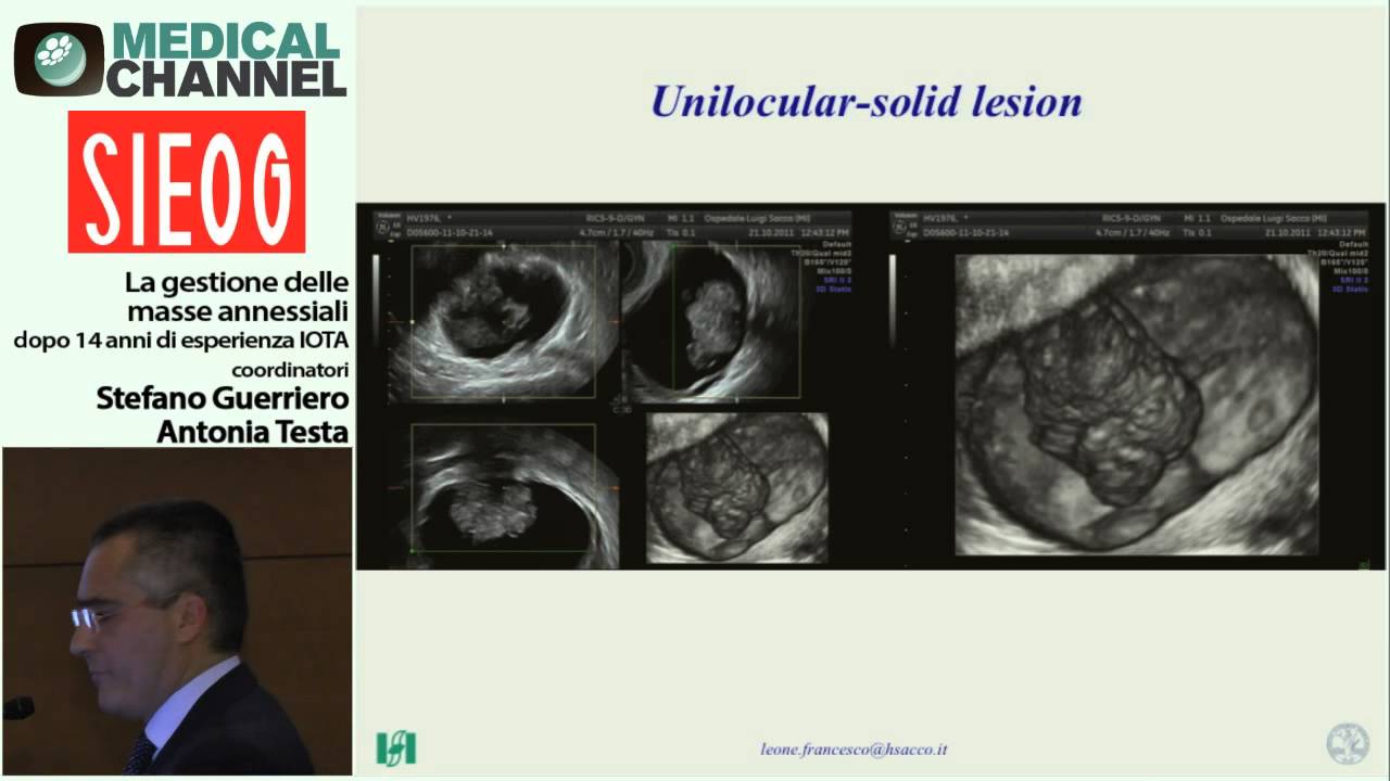 Watch Now Aspetti ecografici delle cisti beninge e maligne - Pattern Recognition Aspetti ecografici delle cisti beninge e maligne - Pattern Recognition