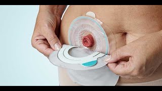 Colostomy bag Urgent apply at patient without peast Complete Procedure in Hindi/Urdu
