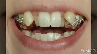 preview picture of video 'Orthodontic treatment sever cross bite'