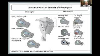 EndoEngage Session 6: Adenomyosis Uncovered: Symptoms, Diagnosis and Treatment Options