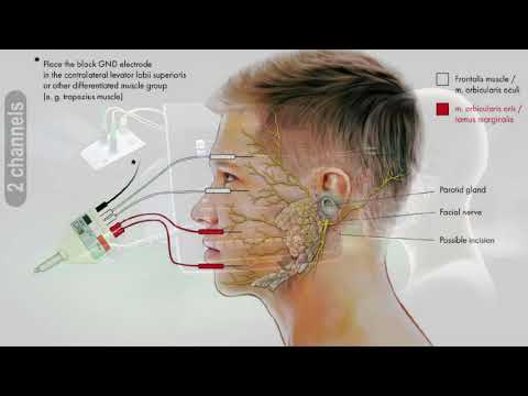 Facial Nerve Monitoring (EMG) with AVALANCHE®SI2