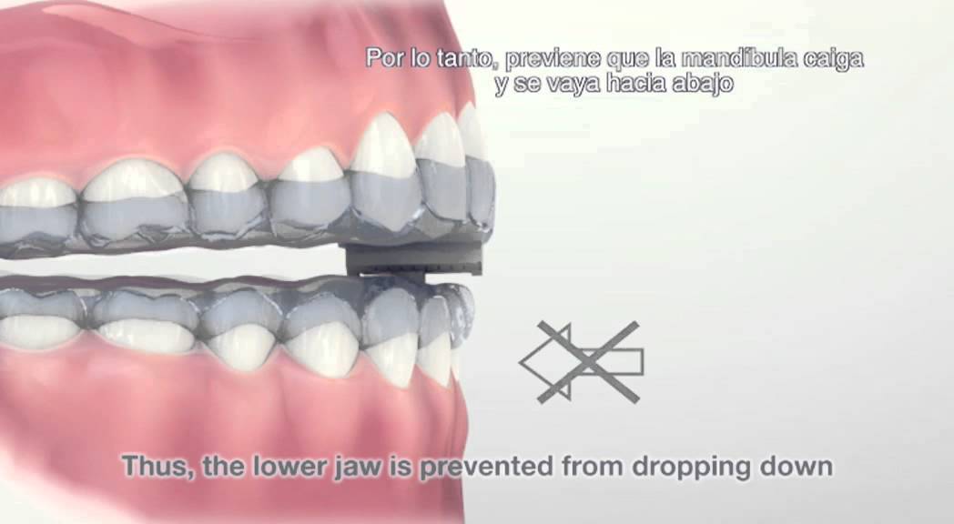 Watch FERULA TAP - LA SOLUCIÓN PARA EL RONQUIDO.mov Now FERULA TAP - LA SOLUCIÓN PARA EL RONQUIDO.mov