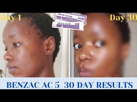 Benzac ac 5% (Benzoyl Peroxide)/ 30 DAY review + what you need to know / South African YouTuber