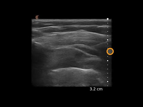 Subacromial Injection – Ultrasound Image Interpretation