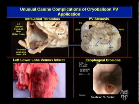 Avoiding Complications During Atrial Fibrillation Ablation - Dr. Munger, Mayo Clinic