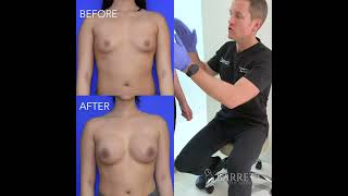 Before and After | Breast Augmentation | Dr. Daniel Barrett | Plastic Surgery | Beverly Hills