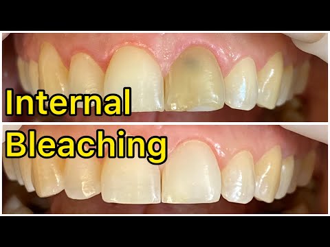 30 years old female / tooth discoloration / internal bleaching / Dr Sara / dentist / Bleaching