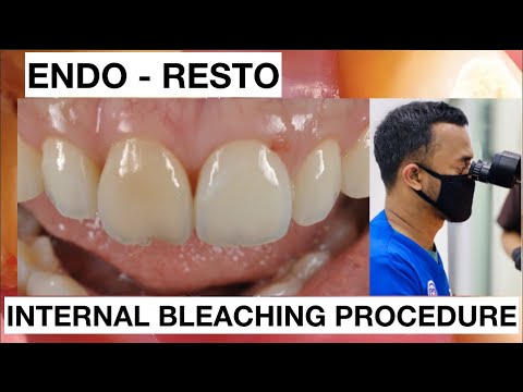 Step by Step Internal Bleaching Teeth Discoloration + Direct Restoration