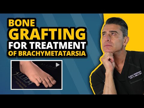 Brachymetatarsia - A Bone Grafting Process to Treat It