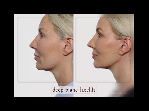 Debunking the Biggest Facelift Myths — Dr. Jonathan Zelken