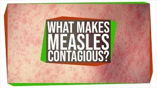 Why Is The Measles Virus So Contagious?