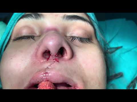 Video On Redo Cleft Rhinoplasty