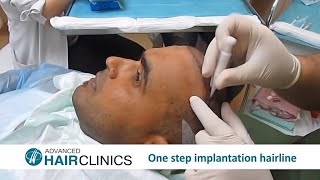 Μεταμόσχευση μαλλιών: διαδικασία _ Δρ.Αναστάσιος Βεκρής