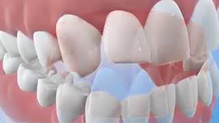 Movimientos dentales con Invisalign