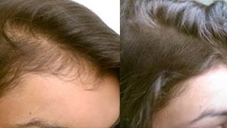 Hair growth serum | Must watch