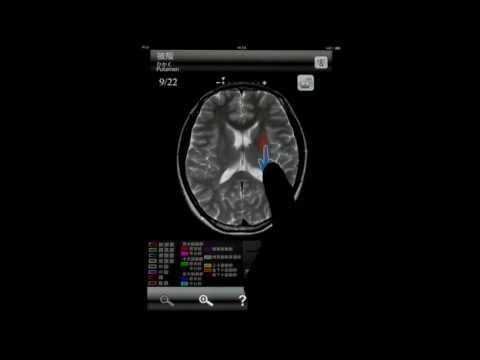 断面図ウォーカー脳MRI Video