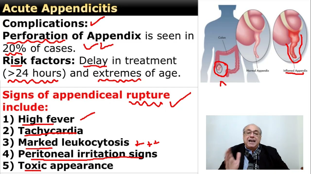 Acute Appendicitis     #internal_medicine  #cme #usmle #محاضرات_باطنة