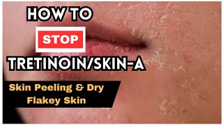 How To Prevent Skin-A/Tretinoin Skin Peeling & Dry Flakey Skin