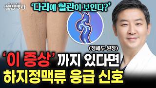 다리에 혈관 보이지 않아도 '이 증상' 있다면 하지정맥류? 초기 신호 절대 놓치지 마세요