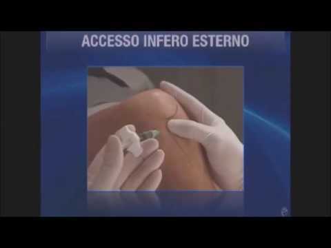 20 minuti contro a osteocondrosi sacrale lombare Di malattie degenerative del disco moderato