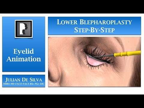 Blepharoplasty Animation – How is Lower Blepharoplasty/ Eyelid Surgery completed?