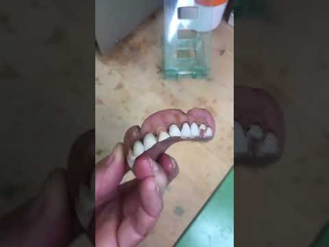 Prothese eines Patienten (er weigert sich, die Prothese in BRD reinigen zu lassen)￼