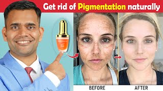 How To Get Rid Of Hyperpigmentation ( Ageing or Dark Spots) | Naturally Get Rid Of Hyperpigmentation