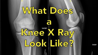 What Does a Knee X Ray Look Like