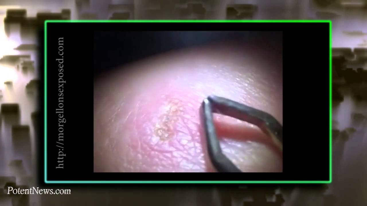Morgellons Syndrome
