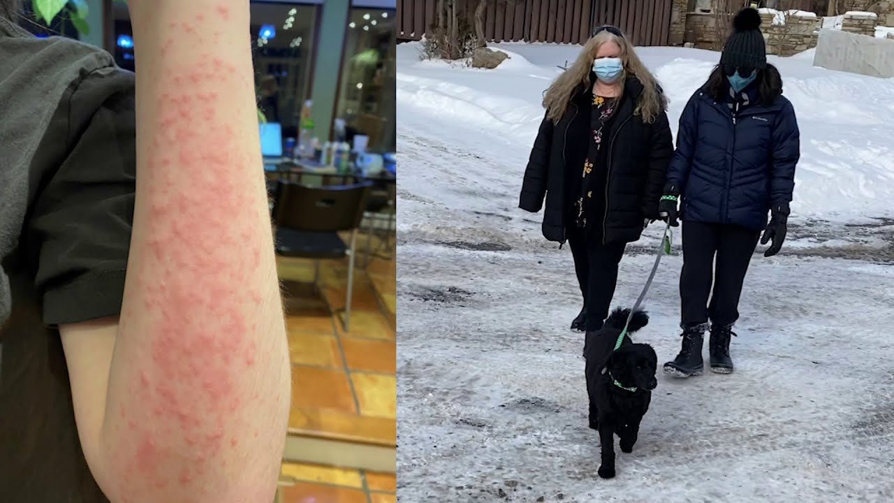 Montreal Teen Allergic to the Cold-Interview with Dr. Ben-Shoshan