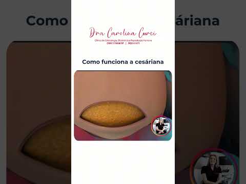 🤰 Como Funciona a Cesariana?