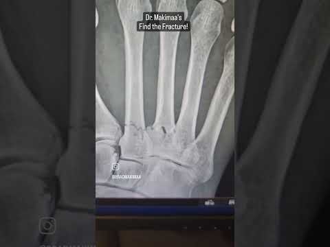 Find the fracture - multiple metatarsal fractures