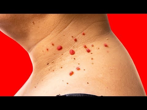 How to remove skin papilloma