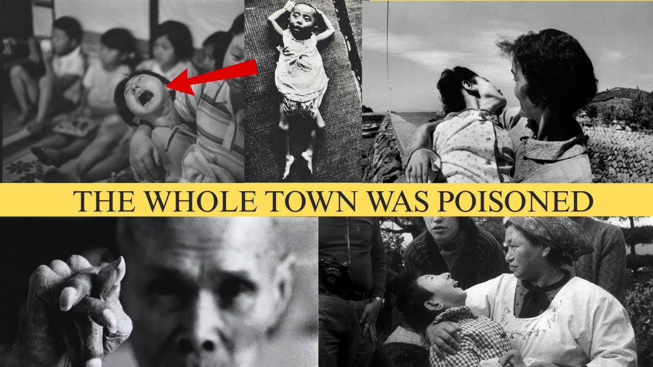 Minamata Mercury Disaster and the 'Dancing Cat Disease¨ of Japan