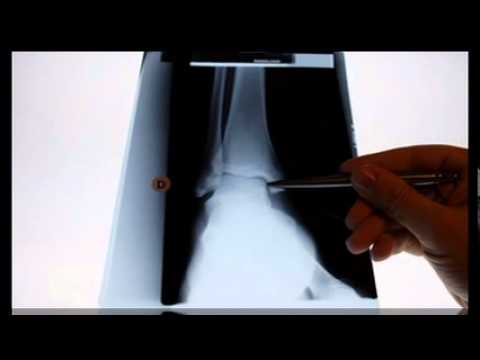 Lateral Process of Talus Injury in Snowboarders