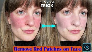 How to Remove Red Patches on Face #shorts