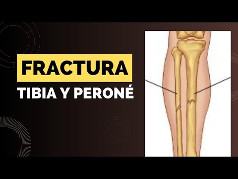 FRACTURE OF THE TIBIA AND FIBULA. THE TIBIA HAS SOLIDIFIED BUT THE FIBULA REMAINS FRACTURED