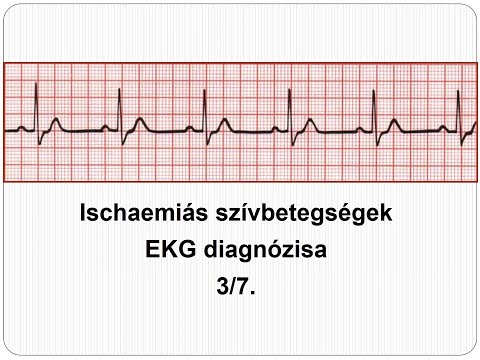 magas vérnyomás tachycardia hogyan kell kezelni)