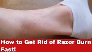 Revealed: Pro Secrets on How to Get Rid of Razor Burn Fast!