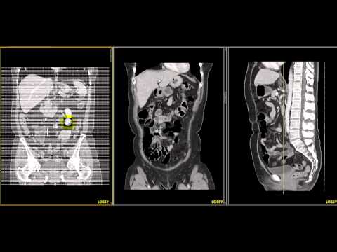 tc abdomen supramesocolico