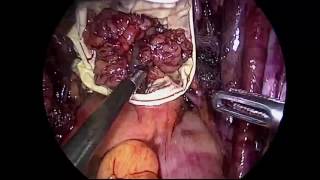 Laparoscopic Repair of Obturator Nerve Injury in Pelvic Lymphadenectomy