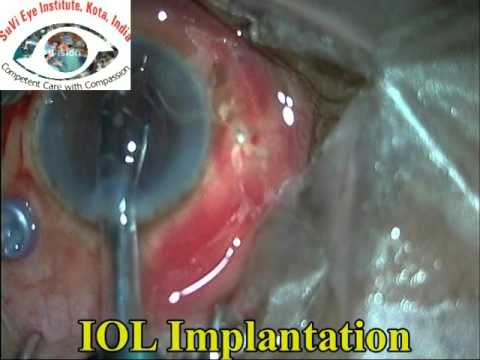 Nucleus Drop Management Surgery