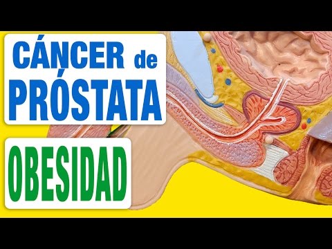 Que relación tiene la obesidad con el cáncer de próstata
