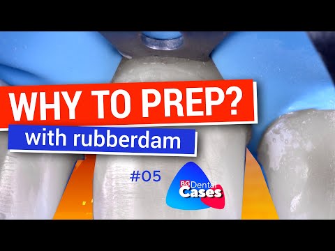 Why To Prep With Rubberdam? - Clinical Case