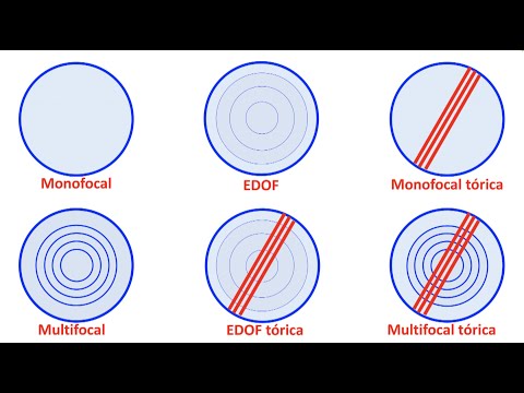 Selección de lentes intraoculares antes de la cirugía de cataratas