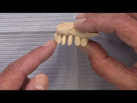 Case of the Week #85: Custom Abutment Engineering