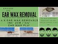 4 X EAR WAX REMOVAL INC 2CM : 3:4" EAR WAX PLUG REMOVAL   EP372