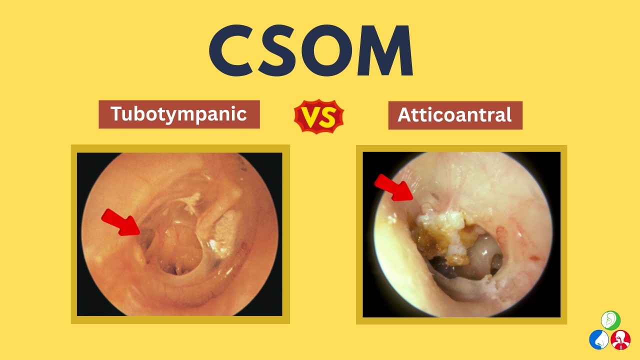 Video thumbnail for Chronic Suppurative Otitis Media (CSOM)